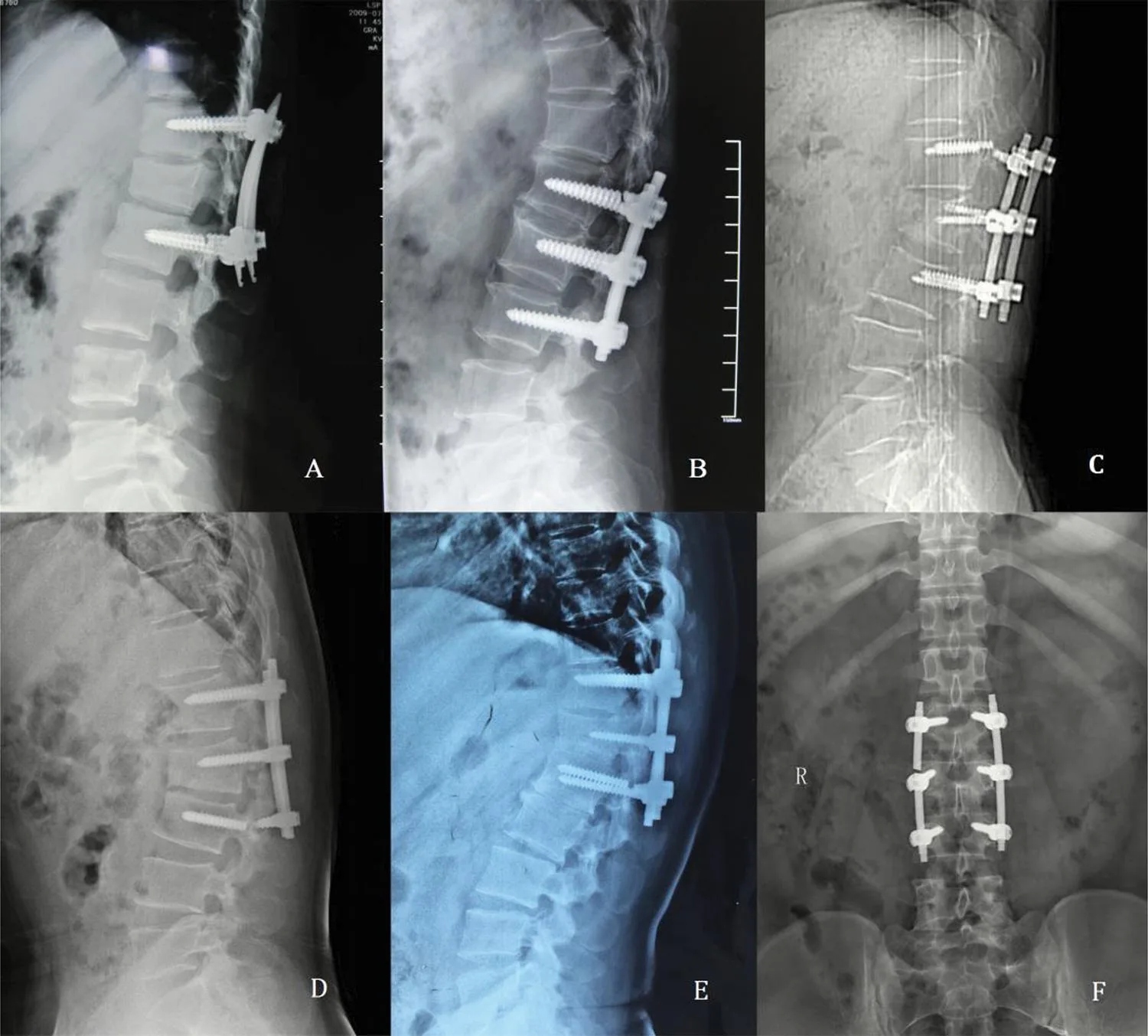Exploring the Benefits of HA Coated Break Thru Poly Axial Screws in Orthopedic Surgery